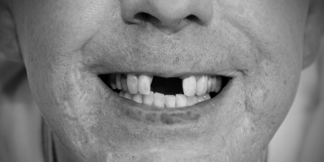 Homem sorrindo sem os dentes da frente
