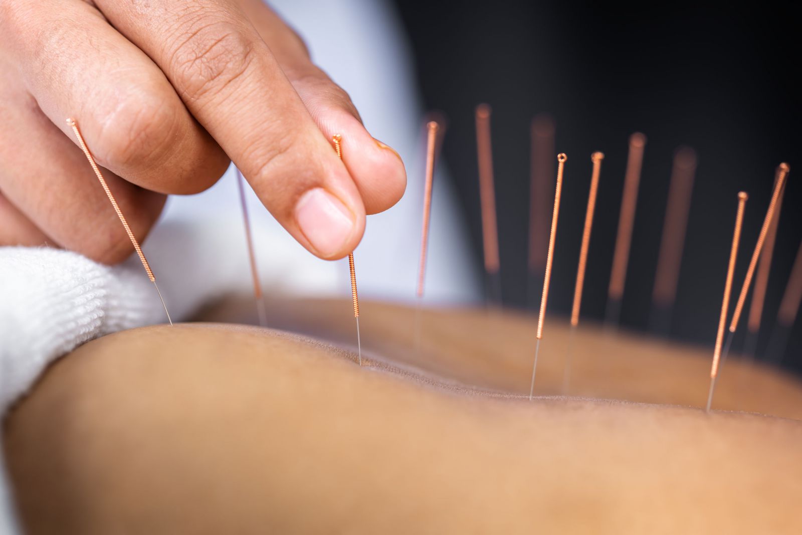 Pessoa fazendo acupuntura 
