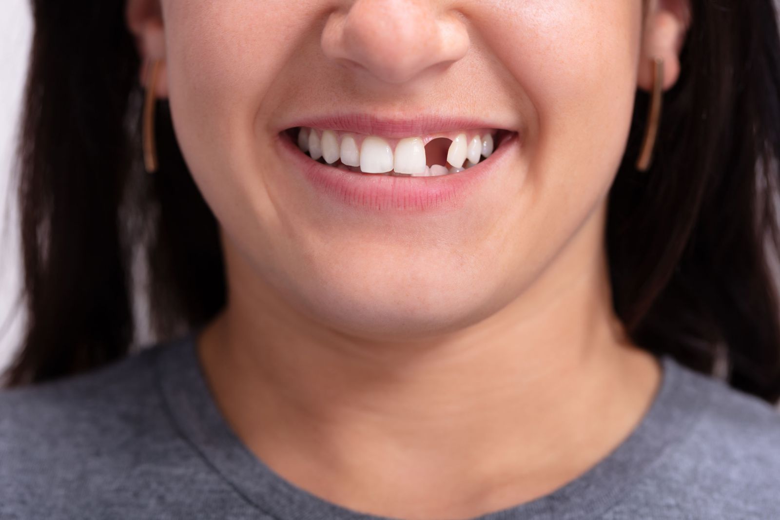 Mulher sorrindo com dente quebrado