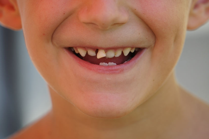 Boca de criança branca com dente caindo.