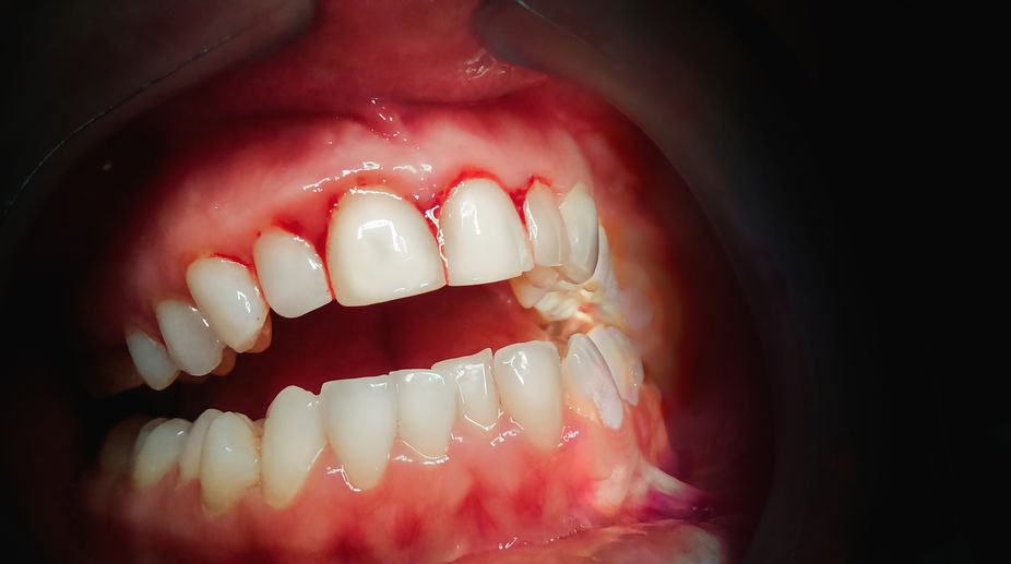 Sonhar com dente sangrando – O que significa este sonho?