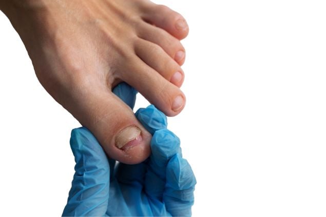 Unha quebrada do pé sendo analisada por um médico