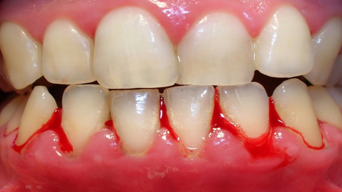 Sonhar com dente sangrando – O que significa este sonho?